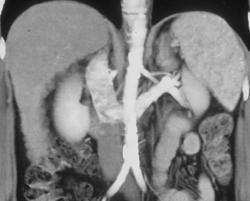 Retroaortic Left Renal Vein - CTisus CT Scan