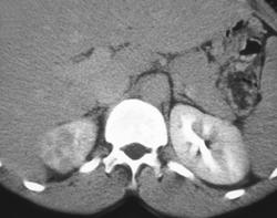 Acute Pyelonephritis Only Seen on Late Phase Images - CTisus CT Scan