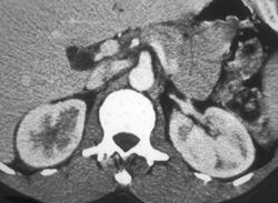 Acute Pyelonephritis - CTisus CT Scan