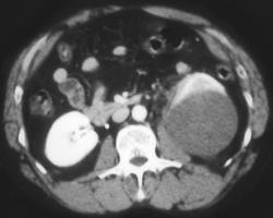 Renal Cancer Simulates An Abscess - CTisus CT Scan