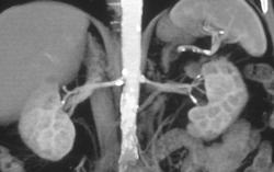 Renal Artery Stenosis - CTisus CT Scan