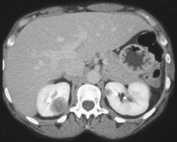 Renal Abscesses - CTisus CT Scan