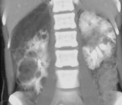 Multiple Renal Angiomyolipomas - CTisus CT Scan