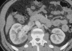 Renal Cell Cancer Invades the Right Renal Vein and IVC - CTisus CT Scan