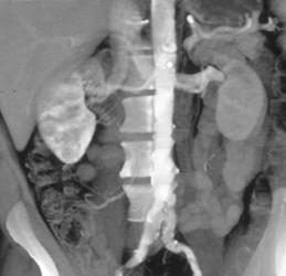 Atherosclerotic Disease in A Potential Renal Transplant Donor - CTisus CT Scan