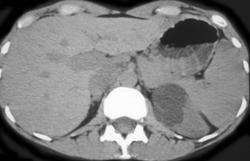 Renal Cyst - CTisus CT Scan