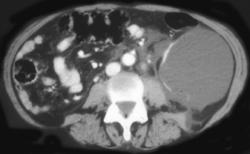 Complicated Renal Cyst - CTisus CT Scan