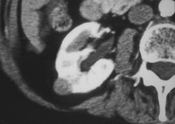 1 Cm Renal Carcinoma - CTisus CT Scan