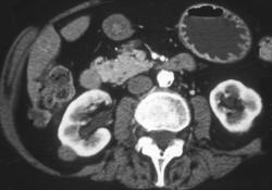 1 Cm Renal Cell Carcinoma - CTisus CT Scan