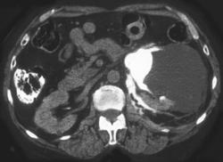 Contrast Extravasation Due to Obstructing Stone - CTisus CT Scan