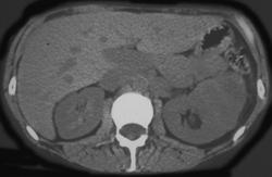 Renal Cell Carcinoma - CTisus CT Scan