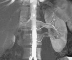 3 Renal Arteries - CTisus CT Scan