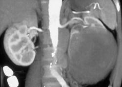 Hypovascular Renal Cell Carcinoma - CTisus CT Scan