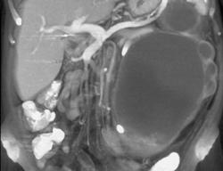 Obstructed Left Kidney - CTisus CT Scan