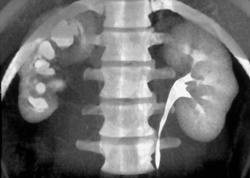 Right Ureteropelvic Junction (UPJ) Due to Crossing Renal Artery and Vein - CTisus CT Scan