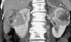 Renal Cell Carcinoma - CTisus CT Scan