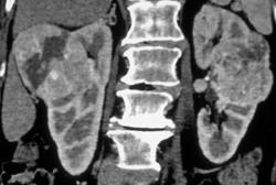 Bilateral Renal Cell Carcinomas - CTisus CT Scan