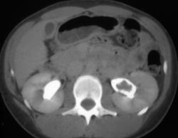 Stone in Left Renal Pelvis - CTisus CT Scan