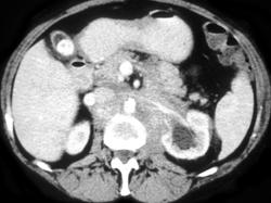 Lymphoma Infiltrates the Kidney - CTisus CT Scan