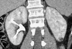 1 Cm Angiomyolipoma Left Kidney - CTisus CT Scan