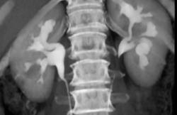 Ct Urogram - CTisus CT Scan