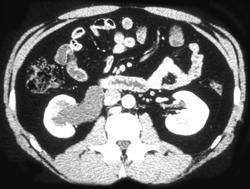 Right Renal Pelvis Obstruction Due to Stone - CTisus CT Scan