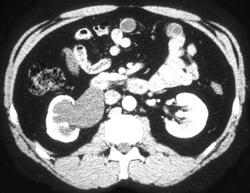 Obstruction of Right Kidney - CTisus CT Scan