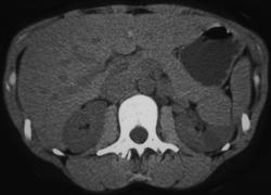 High Density Renal Cyst - CTisus CT Scan