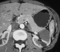 High Density Renal Cyst - CTisus CT Scan