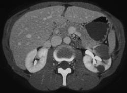 High Density Renal Cyst - CTisus CT Scan