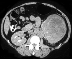 Renal Cell Carcinoma With Adenopathy - CTisus CT Scan