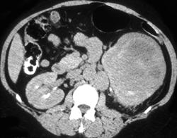 Renal Cell Carcinoma - CTisus CT Scan