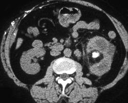 Pyelonephritis With Stone Disease - CTisus CT Scan