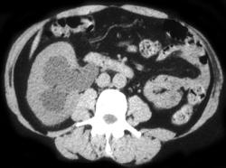 Obstructed Kidney Due to Distal Transitional Cell Carcinoma - CTisus CT Scan