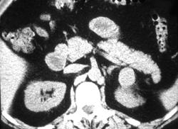 Cystic Renal Cell Carcinoma - CTisus CT Scan