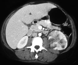 Acute Pyelonephritis - CTisus CT Scan