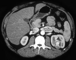 Renal Cell Carcinoma With Renal Vein Clot - CTisus CT Scan