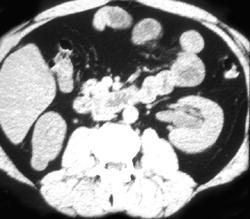 1 Cm Right Renal Cell Carcinoma - CTisus CT Scan