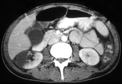 Renal and Splenic Infarct - CTisus CT Scan