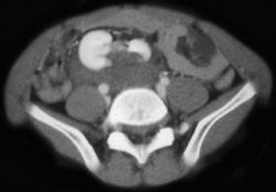 Laceration Through A Pelvic Kidney - CTisus CT Scan