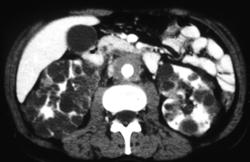 Retroperitoneal Fibrosis With Polycystic Kidney - CTisus CT Scan