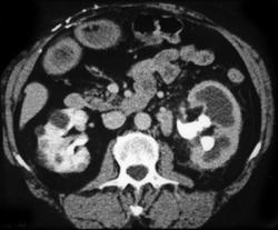 Renal Inflammatory Disease With Stone Disease - CTisus CT Scan