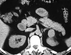 Cystic Renal Cell Carcinoma - CTisus CT Scan