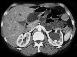 Stones in A Renal Cyst - CTisus CT Scan