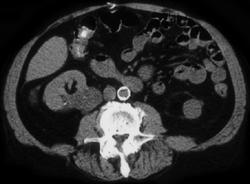 Transitional Cell Carcinoma - CTisus CT Scan