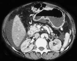 Amyloidosis of the Kidney - CTisus CT Scan