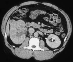 Renal Cell Carcinoma - CTisus CT Scan