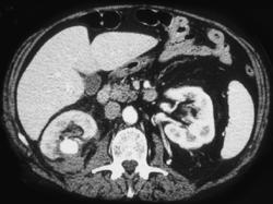 Pseudoaneurysm Post Partial Nephrectomy - CTisus CT Scan