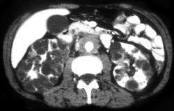 Retroperitoneal Fibrosis in A Patient With Polycystic Kidneys - CTisus CT Scan