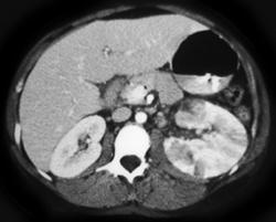 Acute Pyelonephritis - CTisus CT Scan